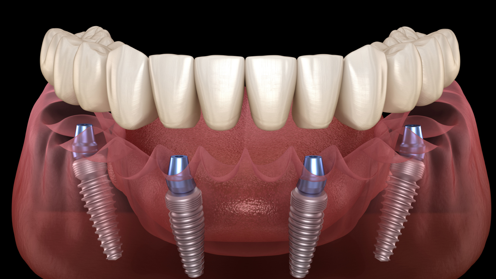 All-on-4 Implants