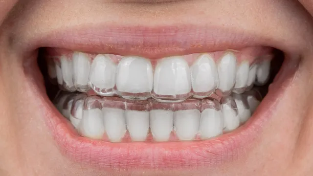 Clear Aligner Trays