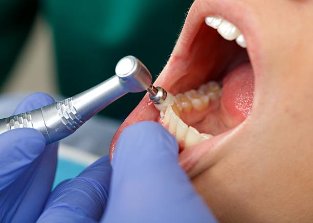 Professional Dental Cleaning