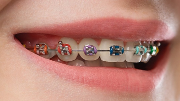 What is Orthodontic Treatment