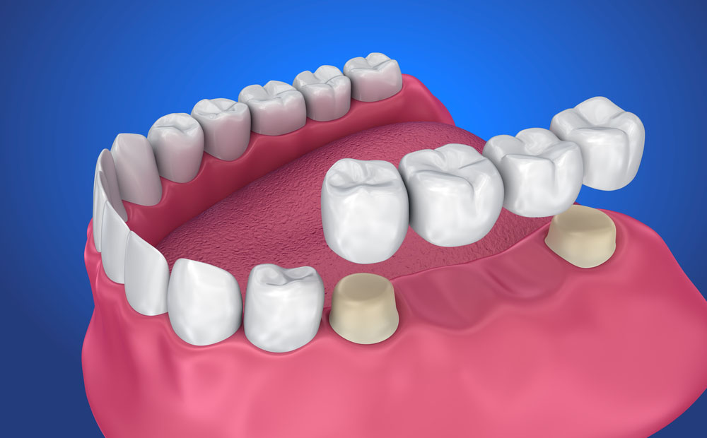Zirconia Crown Restorations