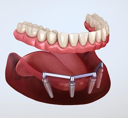 Implant Supported Overdentures