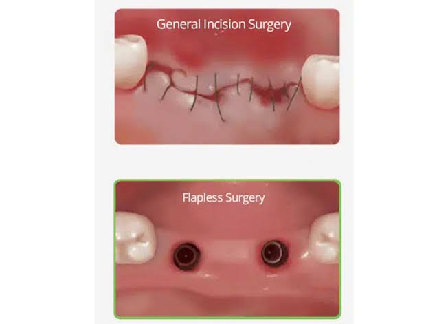 Keyhole Implants