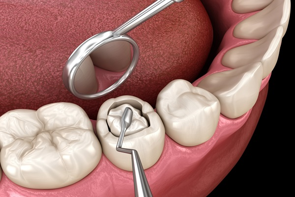 Multiple Tooth Implants
