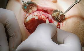 TAD Implants
