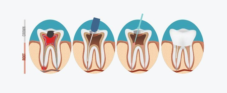 All-on-4 Implants