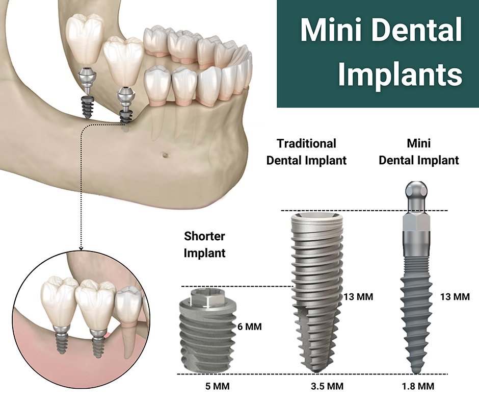 Mini Implants