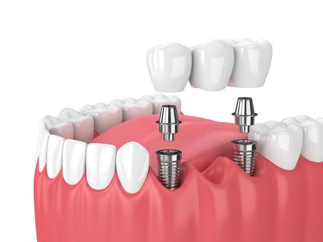 Multiple Tooth Implants
