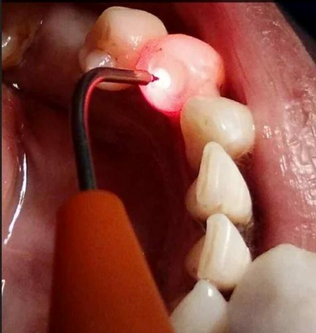 Laser Root Canal