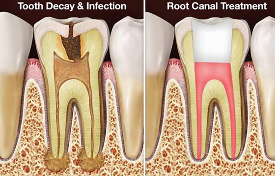 Dental Crown Technology
