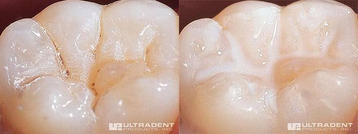 Zygomatic Implants