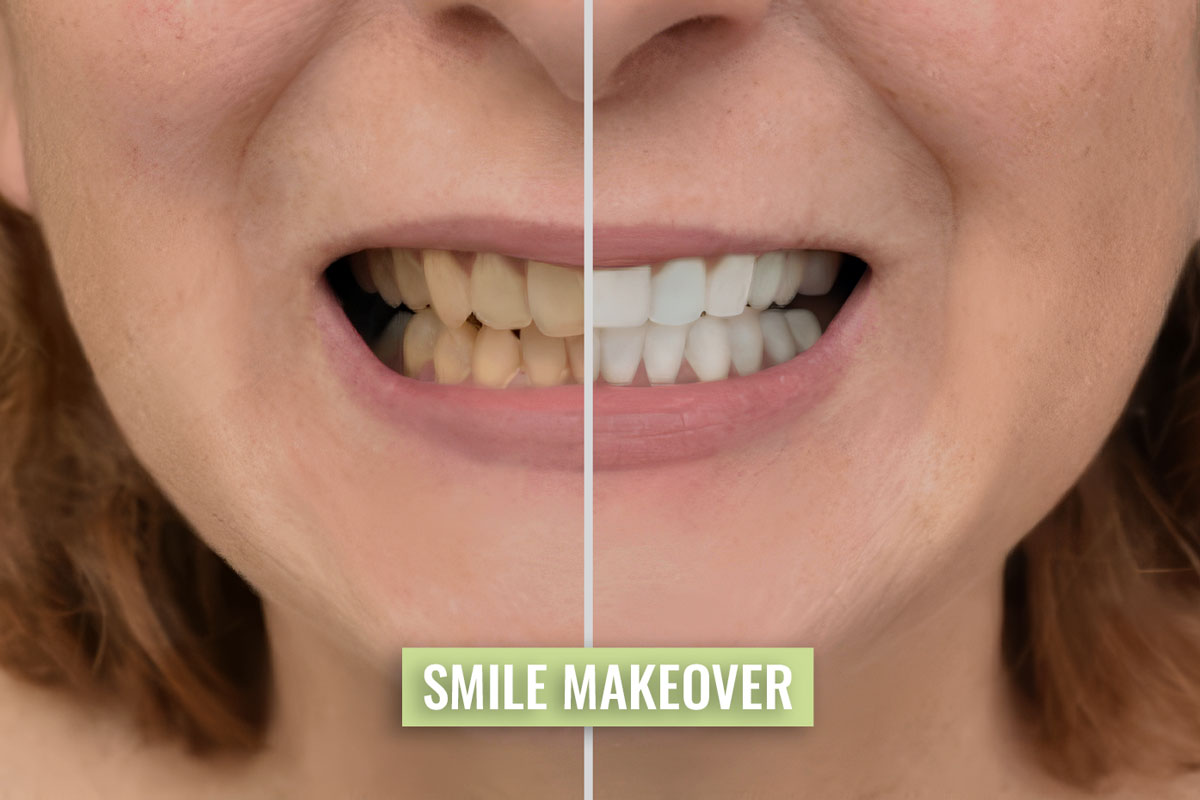 Aesthetic Smile Transformation