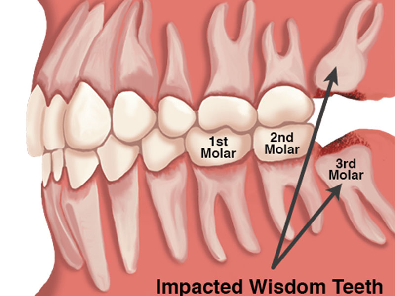 Digital Wisdom Tooth Planning